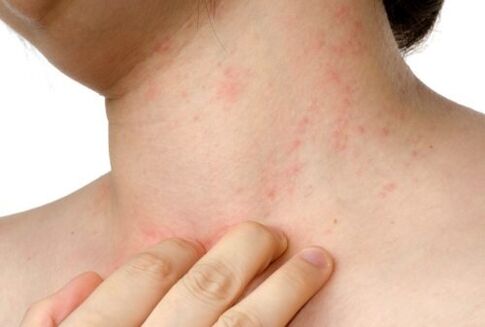 alergija na potkožne parazite