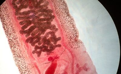 Anquilostomosis kod ljudi